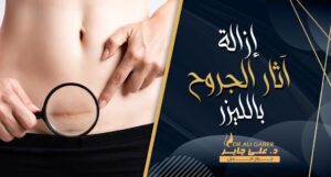 Read more about the article ازالة آثار الجروح والندبات القديمة بالليزر بالوجه واليد