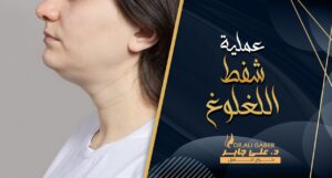 Read more about the article عملية شفط اللغلوغ لعلاج الذقن المزدوج وشد الرقبة