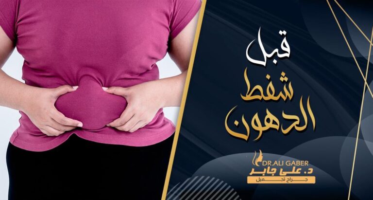 Read more about the article قبل وبعد شفط الدهون | دكتور علي جابر