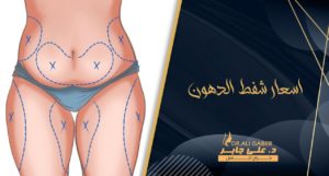 Read more about the article اسعار عمليات شفط الدهون 2022 وأهم المميزات والعيوب