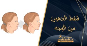 Read more about the article شفط الدهون من الوجه