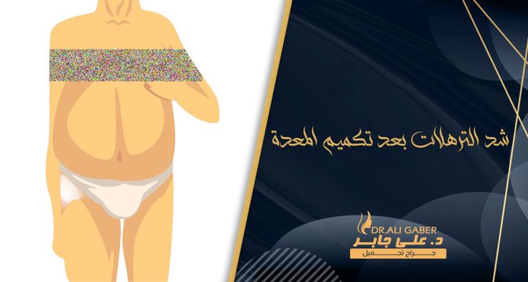 Read more about the article شد الترهلات بعد تكميم المعدة أو فقدان الوزن