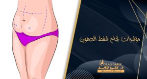 Read more about the article 7 مؤشرات تدل على نجاح عملية شفط الدهون