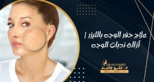 Read more about the article علاج حفر الوجه بالليزر | أزالة ندبات الوجه