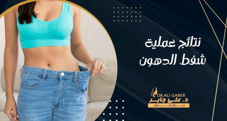 Read more about the article نتائج عملية شفط الدهون