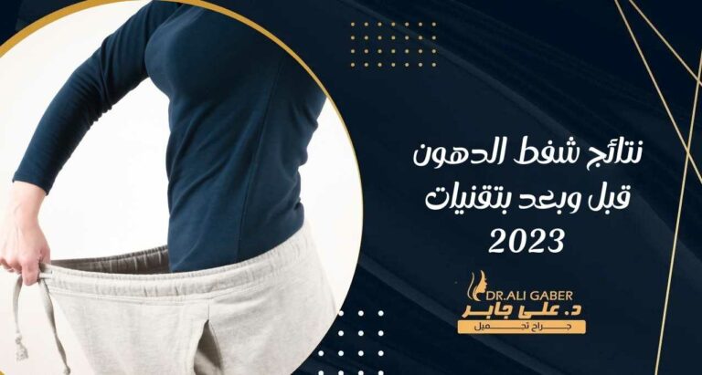 Read more about the article نتائج شفط الدهون قبل وبعد  بتقنيات 2023